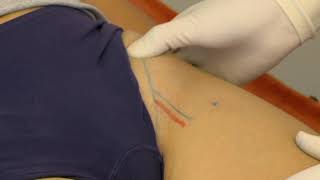 Injection for psoas bursitis [upl. by Aubin]