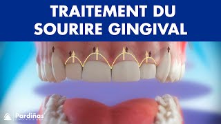 Gingivectomie  Traitement du sourire gingival © [upl. by Ivana33]