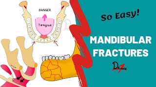 Mandibular Fractures  Basics  DENTAL NOTES [upl. by Aeiram]