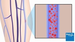 How superficial thrombophlebitis develops [upl. by Nolak463]