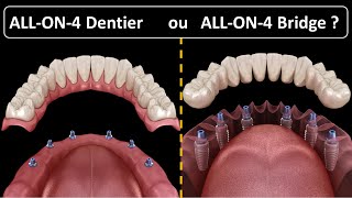 All on 4  Type de prothèse  Dentier ou Bridge [upl. by Llieno168]