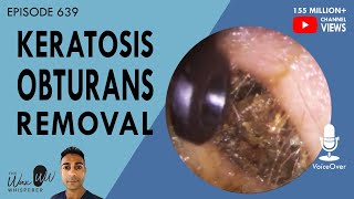 639  Keratosis Obturans Removal [upl. by Einneg]