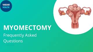 Myomectomy Frequently Asked Questions [upl. by Au870]