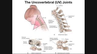 Cervical Epidural Steroid Injection With Patient [upl. by Lennahs]