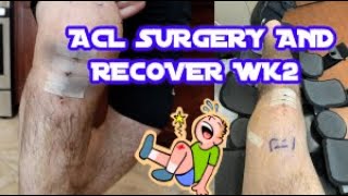 ACL amp Meniscus Surgery  Recovery Week 2 [upl. by Weisbrodt]