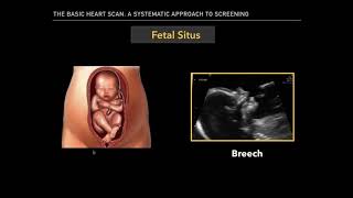 The Basic Fetal Heart Scan [upl. by Coady]