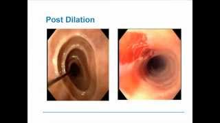 Eosinophilic Esophagitis [upl. by Anierdna]