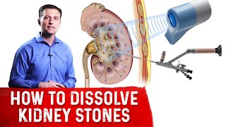 Symptoms of Kidney Stone  Dr Nicholas Laryngakis [upl. by Natalee201]