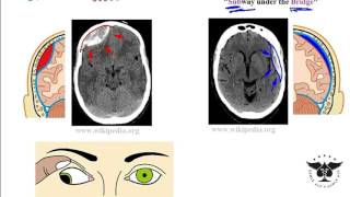 Bleeding in the brain  Dr Avinash K M [upl. by Raasch532]