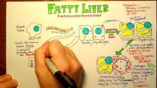 Fatty Liver Pathophysiology [upl. by Akemit]