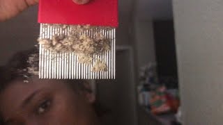 NEW VIDEO scratching my scalp scalp scratching lovescrathers [upl. by Nnylyoj]