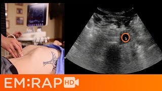 How to do abdominal ultrasound examination [upl. by Aidualk]