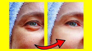 4 Remedios Caseros Para Eliminar Ojeras Y Bolsas Bajo Los Ojos [upl. by Yrrac]