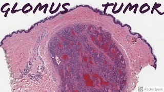 Glomus Tumor 5Minute Pathology Pearls [upl. by Denoting222]