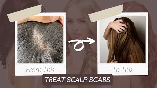 How To Treat Scalp Scabs [upl. by Adest]