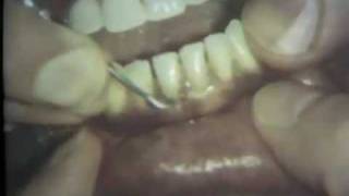 Scaling and Root Planing Part II Mandibular Teeth [upl. by Fenella]