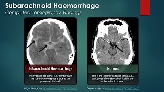 What is a Subarachnoid Hemorrhage [upl. by Hollerman417]