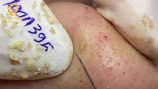 Treatment of blackheads and whiteheads 395  Loan Nguyen [upl. by Arvid]