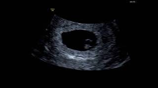 What Can You See At A 6 Week Baby Scan [upl. by Ynoyrb184]