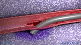 Peripheral IV Infiltration Animation [upl. by Leirda]