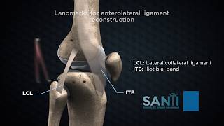 Anterolateral extraarticular procedures combined with ACL reconstruction [upl. by Novia462]