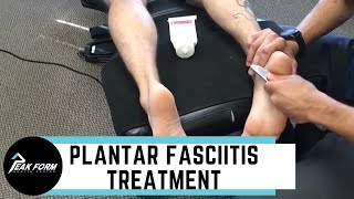 Plantar Fasciitis Treatment San Diego Graston Chiropractic [upl. by Dorene]