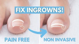 How to Treat Ingrown Toenails [upl. by Eahcim981]