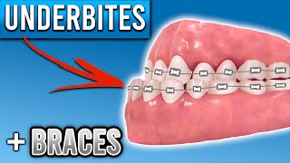 How Do Braces Fix Underbites  Premier Orthodontics [upl. by Emearg]