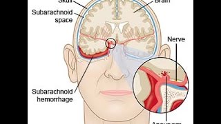 Subarachnoid Hemorrhage [upl. by Randolph]