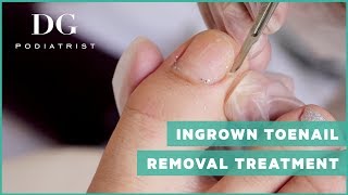 Ingrown toenail removal treatment [upl. by Seidel]