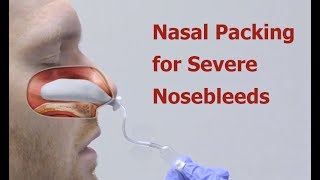 Nasal Packing for Severe Nosebleeds [upl. by Falconer]