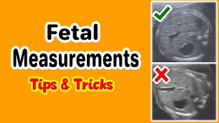 Fetal Measurements Tips and Tricks [upl. by Amalee]