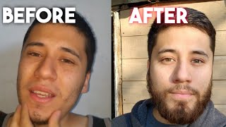 My Minoxidil Beard Journey Is Officially Complete  One Year After Stopping [upl. by Siradal]