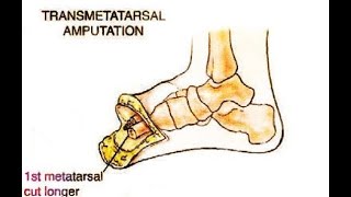 Transmetatarsal Amputation [upl. by Iloj]