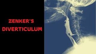 ZENKERS DIVERTICULUM Symptoms Causes TreatmentComplications [upl. by Nirroc]