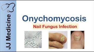 Onychomycosis  Nail Infection  Signs Symptoms Treatment [upl. by Aitnuahs261]