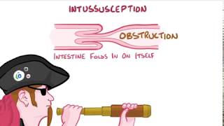 intussusception [upl. by Eselahs330]