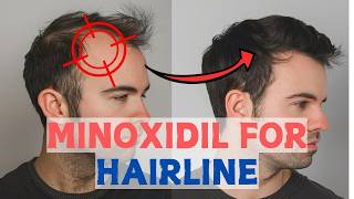 Minoxidil for Frontal Baldness  Restore Your Hairline [upl. by Tiffany]