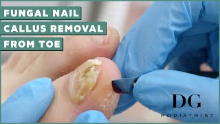 Fungal Nail Treatment And Callus Removal  The Foot Scraper DG Podiatrist [upl. by Aluino98]