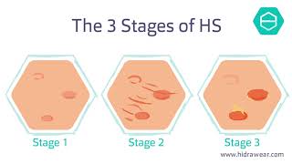 What is Hidradenitis Suppurativa [upl. by Anabelle]