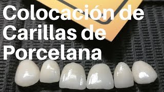 COLOCACIÓN de CARILLAS de Porcelana👅carillasdentales [upl. by Arnst]