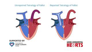 Tetralogy of Fallot Repair [upl. by Leuqar]