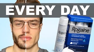 I Put Rogaine On My Face Everyday For A Year Heres What Happened [upl. by Louls]