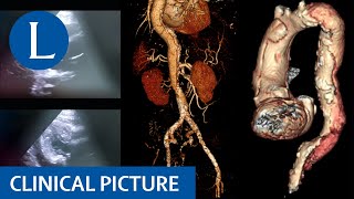 Leg weakness and paraesthesia provides a clue to sudden death [upl. by Airtina]