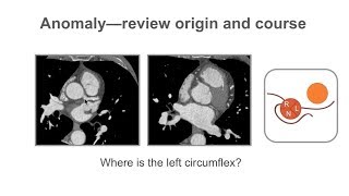 Describing coronary artery anomalies [upl. by Arelc928]