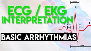 Basic Arrhythmias  Sinus Brady Tachy Premature Beats  ECG EKG Interpretation Part 3 [upl. by Arfihs]