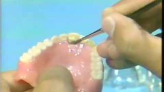 Replacing a Broken Complete Denture Tooth [upl. by Brooks]