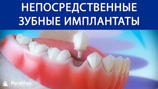 Непосредственные зубные имплантаты после удаление зуба © [upl. by Engedus]