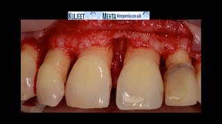 Periodontal Surgery Upper Front Teeth [upl. by Nnylak]