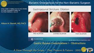 Gastric Bypass Complications I  Obstructions [upl. by Edik]